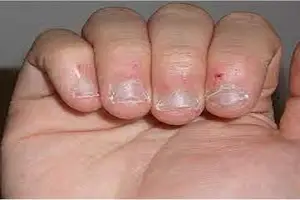 Oslobodite se navike grickanja noktiju: Saveti za prevazilaženje ove nekorisne navike